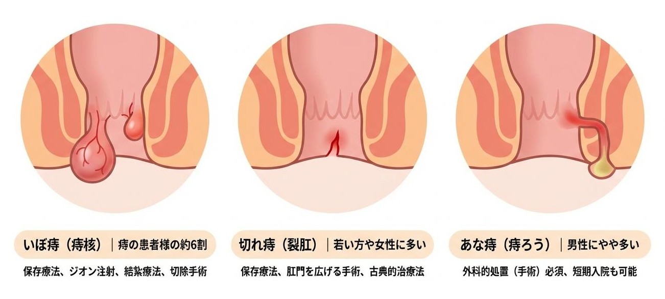 痔の種類と対応する治療法・手術のイラスト