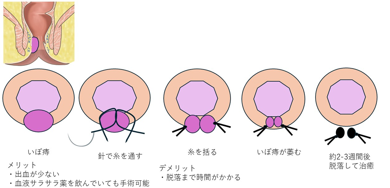 分離結紮のイラスト