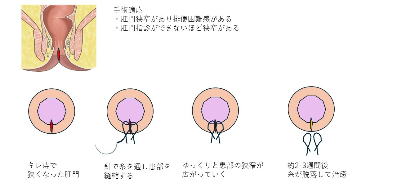 振り分け結紮のイラスト