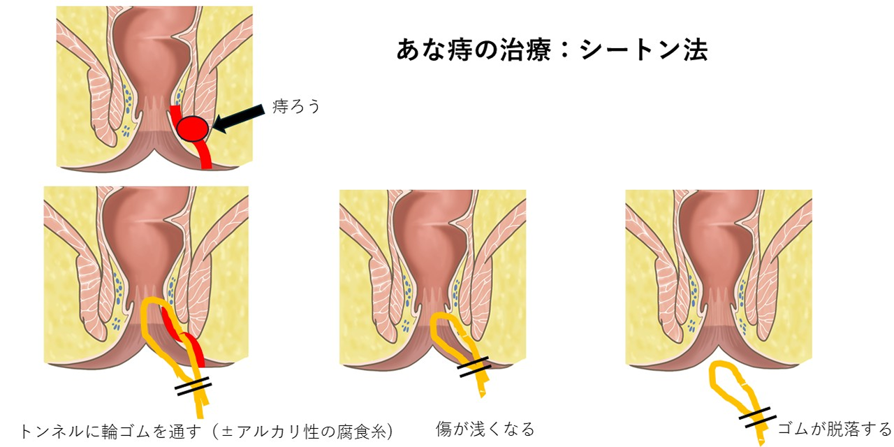 あな痔の治療：シートン法のイラスト